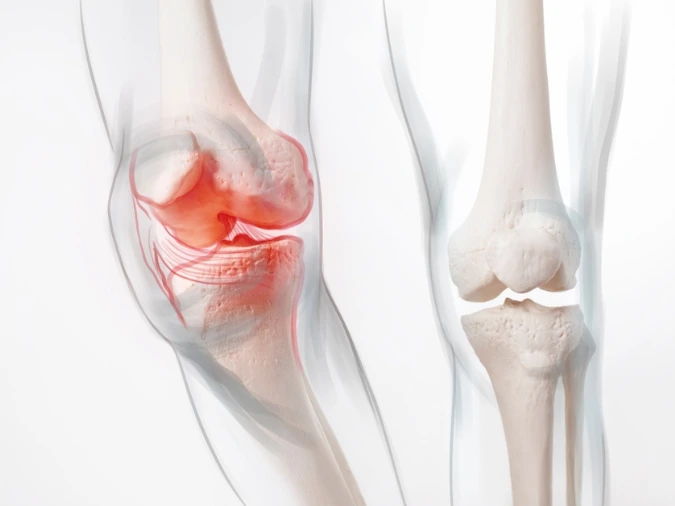 Radiografia di un ginocchio con artrosi e degenerazione della cartilagine