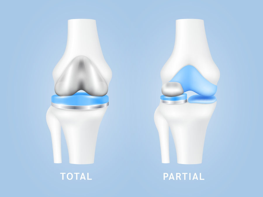 Confronto tra protesi totale e parziale del ginocchio.