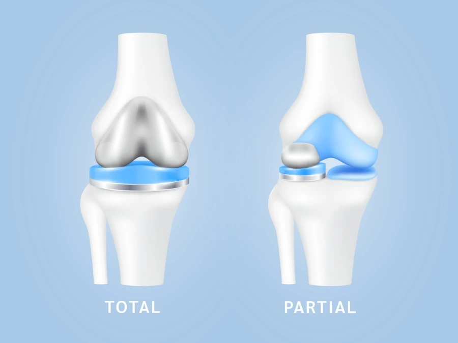 Confronto tra protesi totale e parziale del ginocchio.