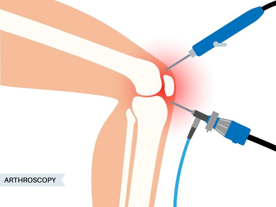 Intervento artroscopico al ginocchio con tecnica mininvasiva.