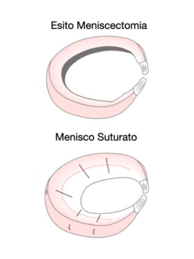 Schema comparativo tra sutura meniscale e meniscectomia selettiva.