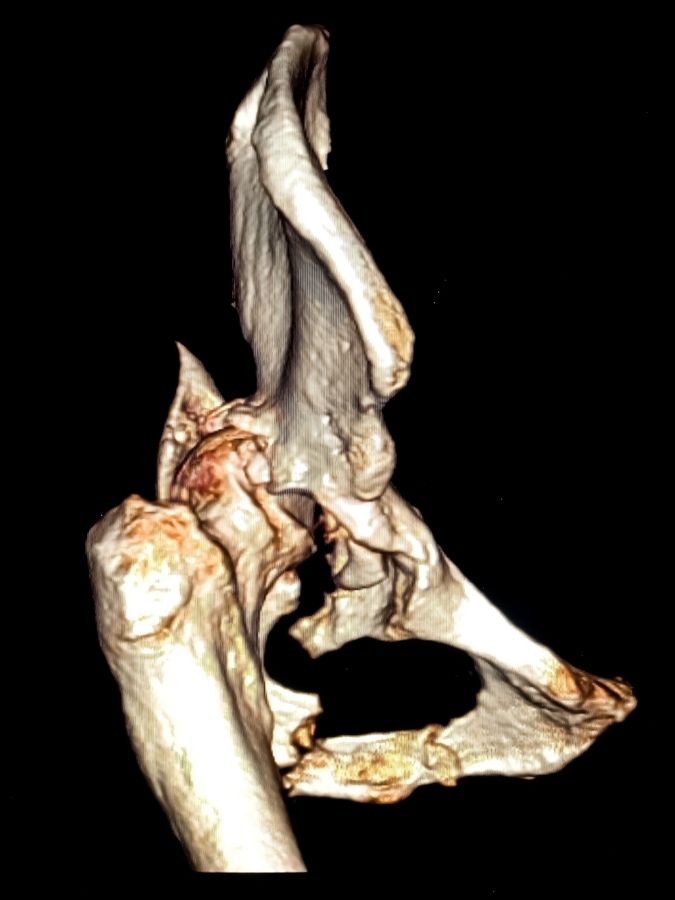 Pianificazione pre-operatoria 3D per intervento di protesi d’anca con software dedicato