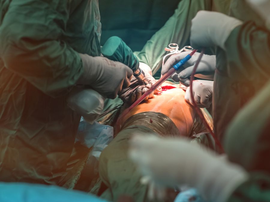 Chirurgo ortopedico durante un intervento di protesi d’anca in sala operatoria.